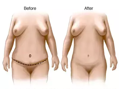 Abdominoplastika (qarın gərmə) nədir?