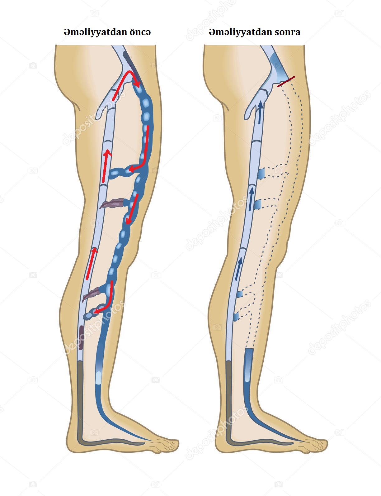 depositphotos_209467538-stock-illustration-poster-varicose-veins-medical-infographics.jpg