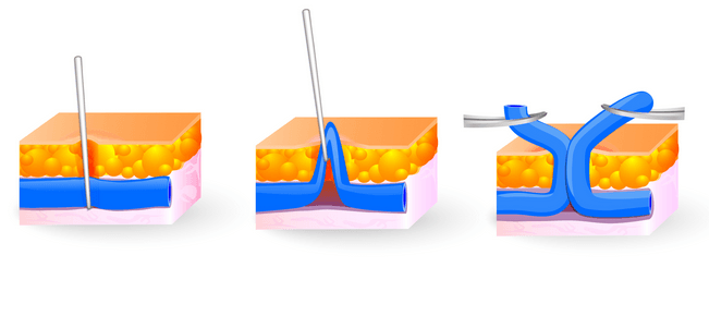mikroflebektomiya1-min_copy.png