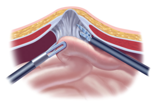 Əməliyyatdansonrakı ventral yırtıq nədir?